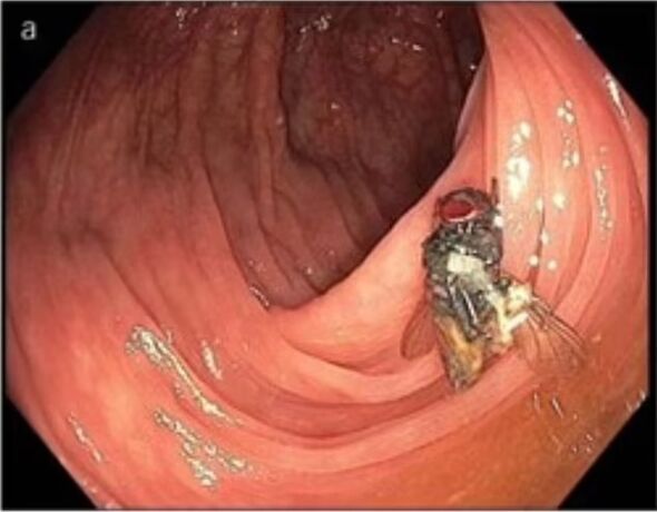 A live fly inside a man's intestine
